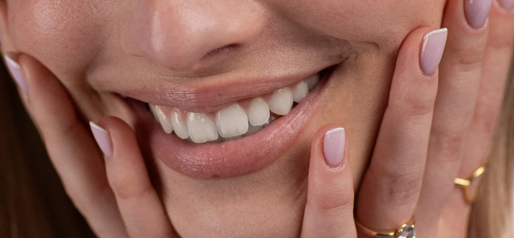 Teeth-Whitening-and-Brightening-after
